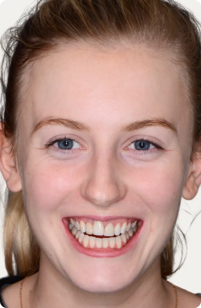 Image of a patient before dental implants at Macquarie Street Dental.