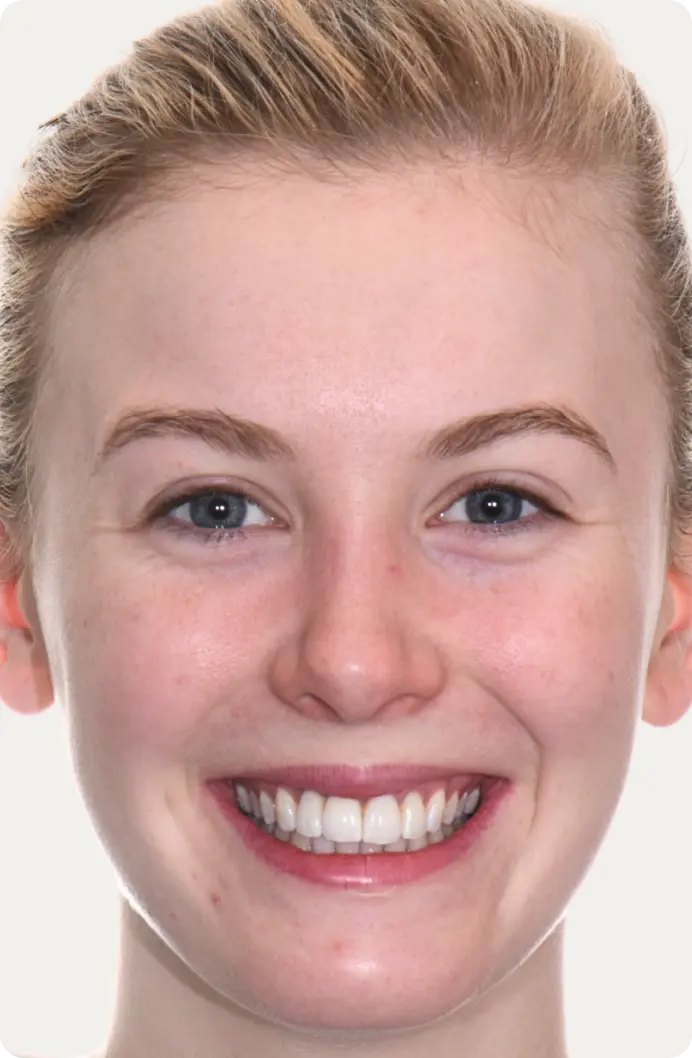 Image of a patient after dental implants at Macquarie Street Dental.