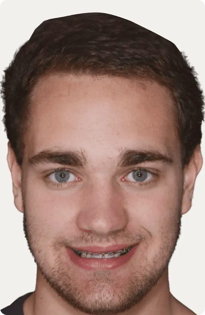 Image of a patient before dental implants at Macquarie Street Dental.