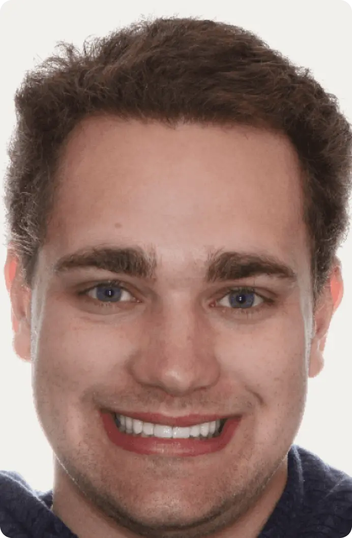 Image of a patient after dental implants at Macquarie Street Dental.