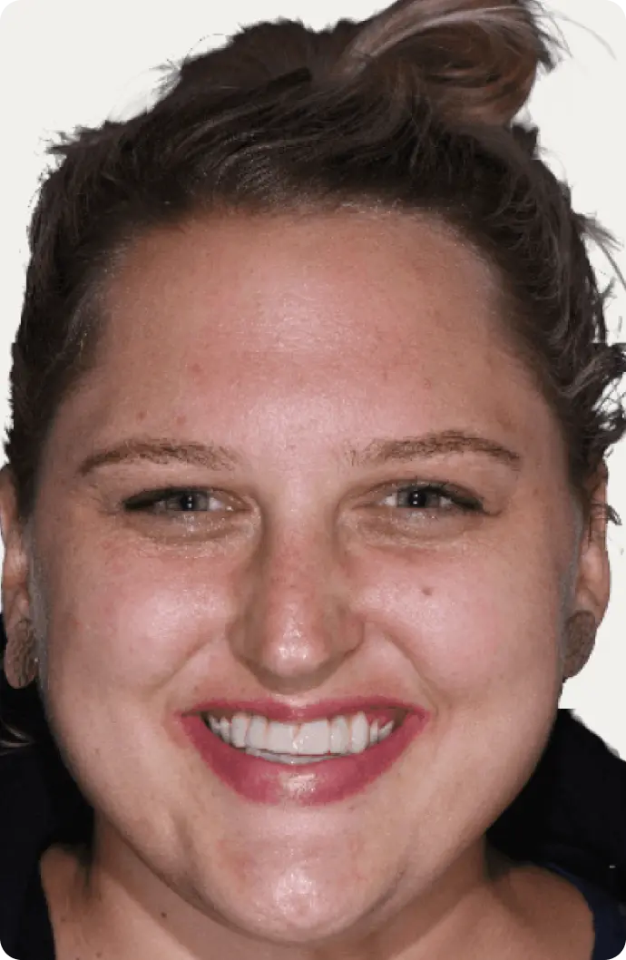 Image of a patient before dental implants at Macquarie Street Dental.