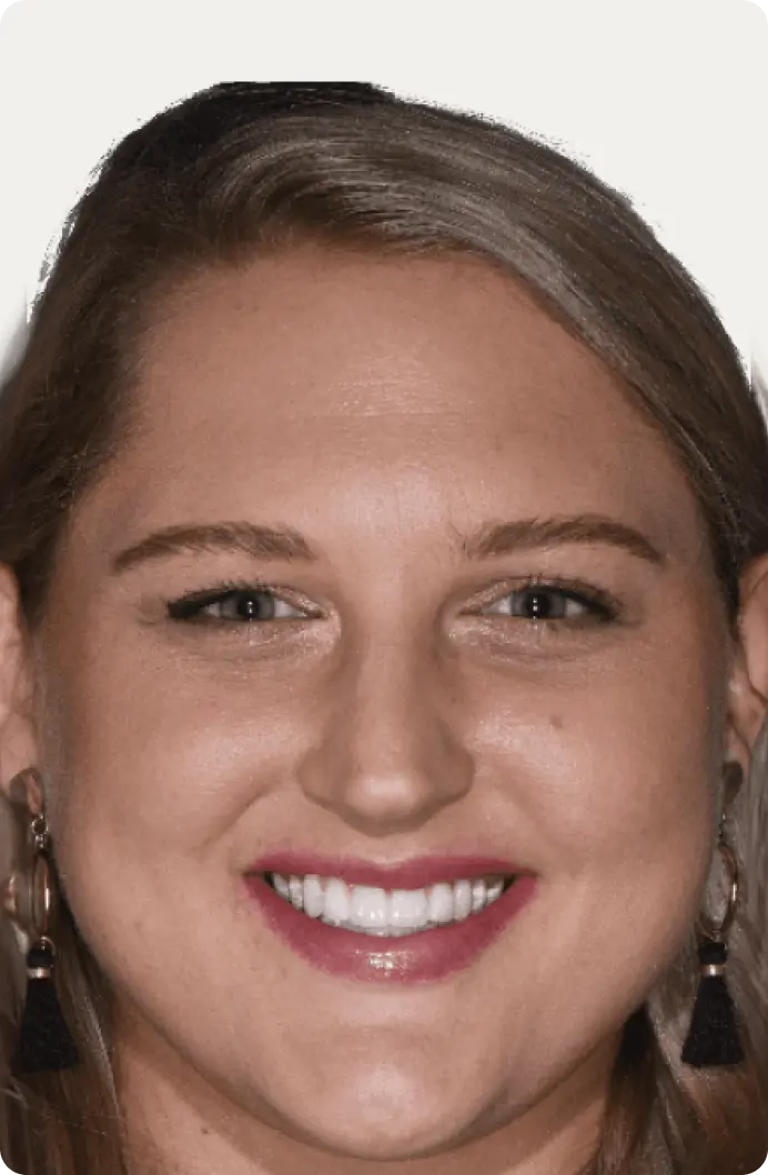 Image of a patient after dental implants at Macquarie Street Dental.