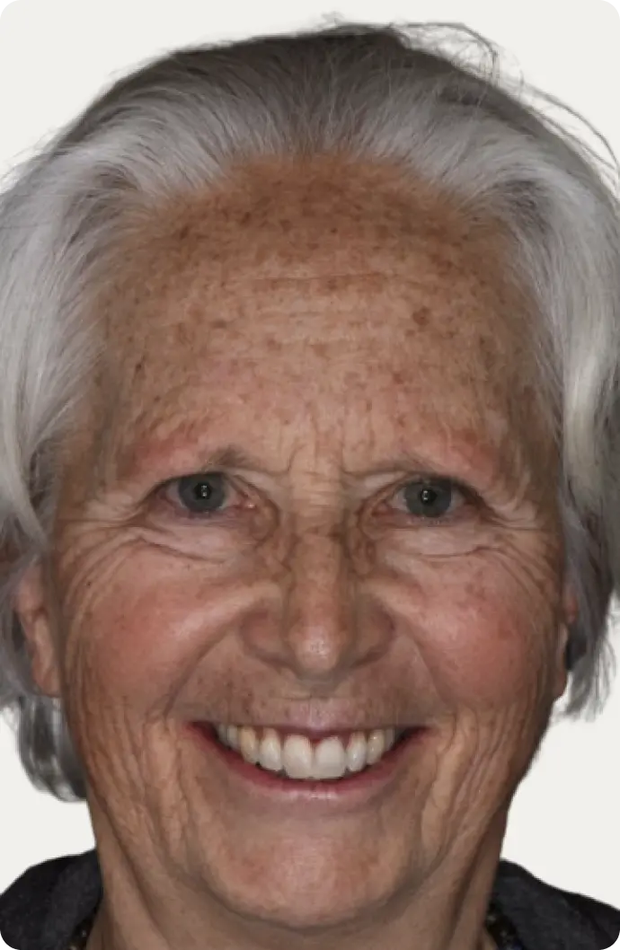 Image of a patient before All-on-4 treatment at Macquarie Street Dental.