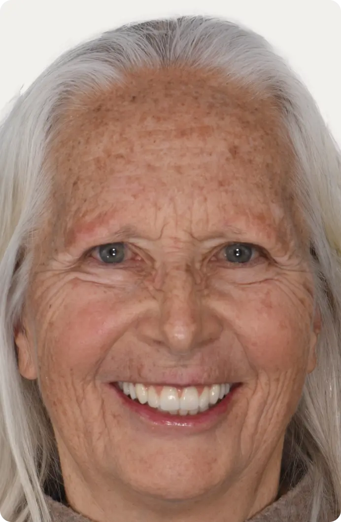 Image of a patient after All-on-4 treatment at Macquarie Street Dental.