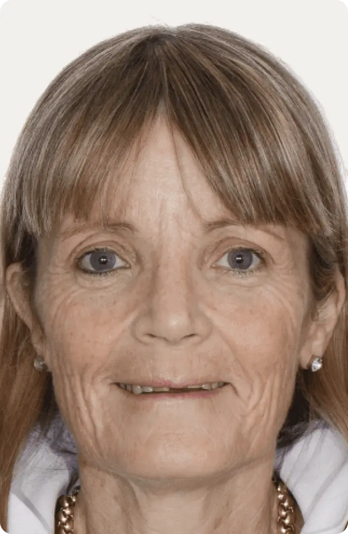 Image of a patient before All-on-4 treatment at Macquarie Street Dental.