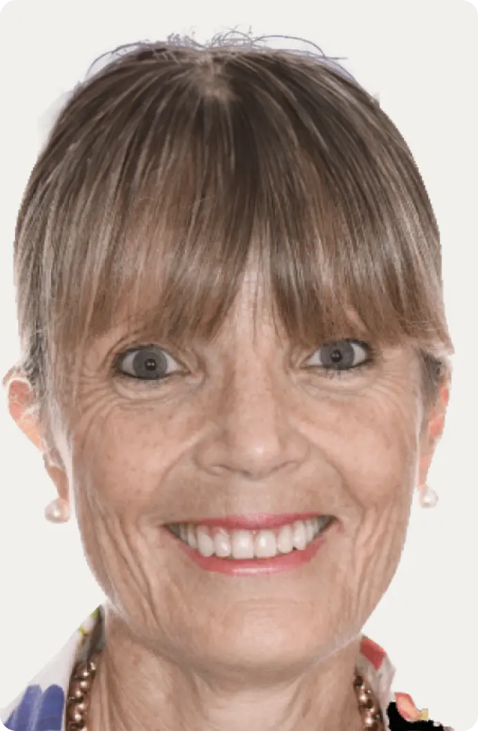 Image of a patient after All-on-4 treatment at Macquarie Street Dental.