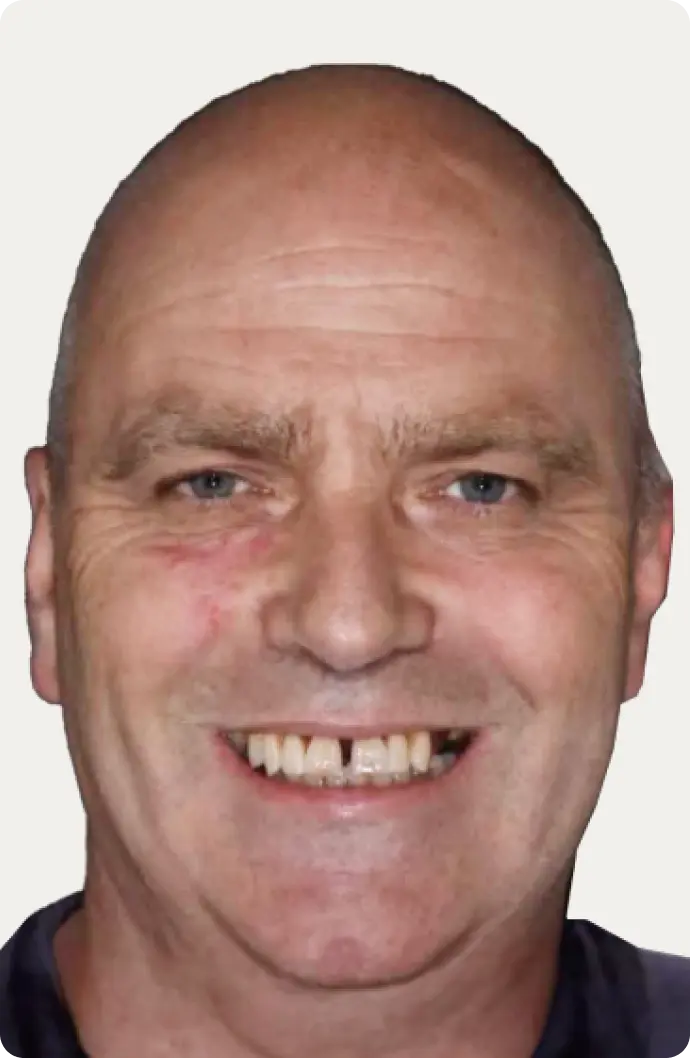 Image of a patient before All-on-4 treatment at Macquarie Street Dental.