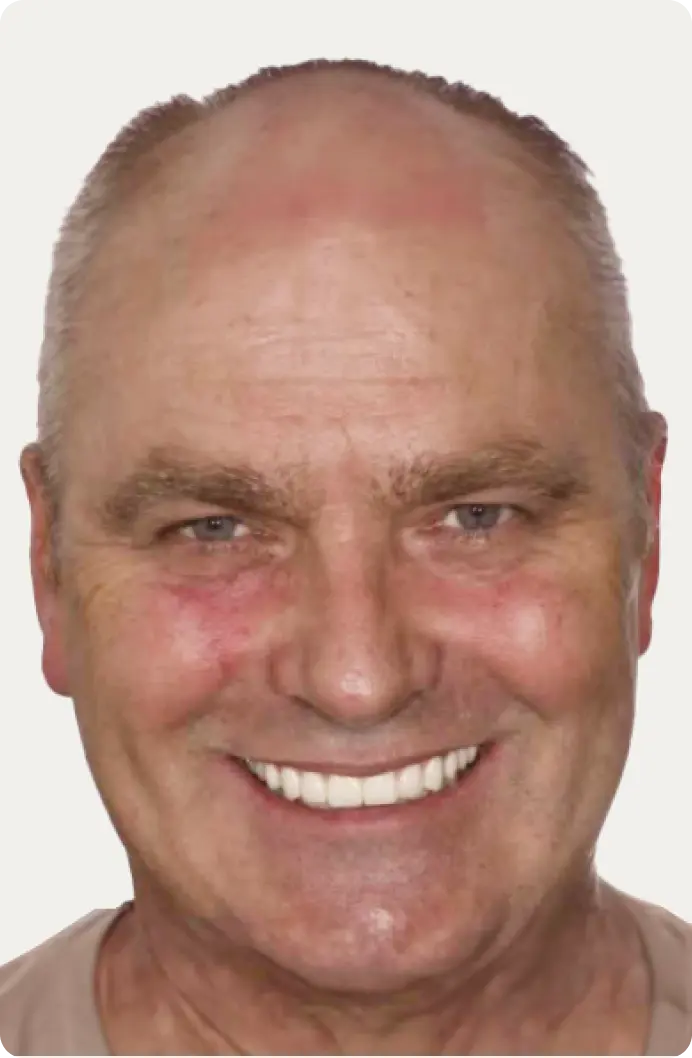 Image of a patient after All-on-4 treatment at Macquarie Street Dental.