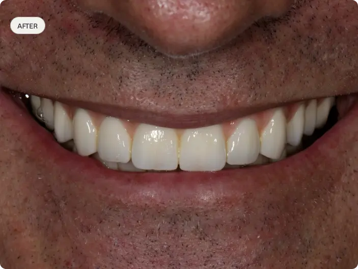 Image of a patient's smile after All-on-4 treatment at Macquarie Street Dental.
