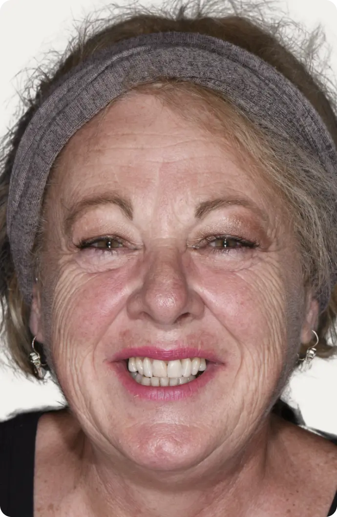 Image of a patient before All-on-4 treatment at Macquarie Street Dental.