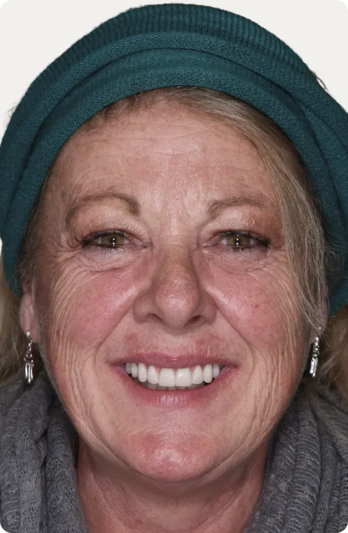 Image of a patient after All-on-4 treatment at Macquarie Street Dental.