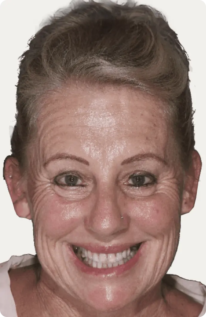 Image of a patient before All-on-4 treatment at Macquarie Street Dental.