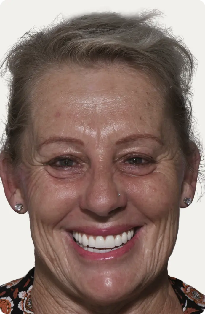 Image of a patient after All-on-4 treatment at Macquarie Street Dental.