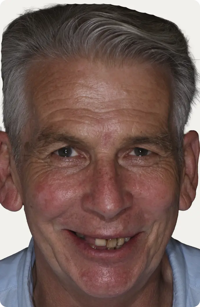 Image of a patient before All-on-4 treatment at Macquarie Street Dental.