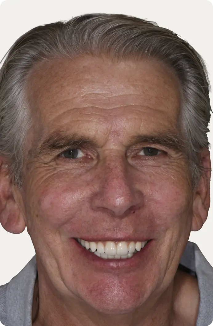 Image of a patient after All-on-4 treatment at Macquarie Street Dental.