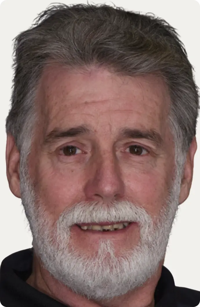 Image of a patient before All-on-4 treatment at Macquarie Street Dental.