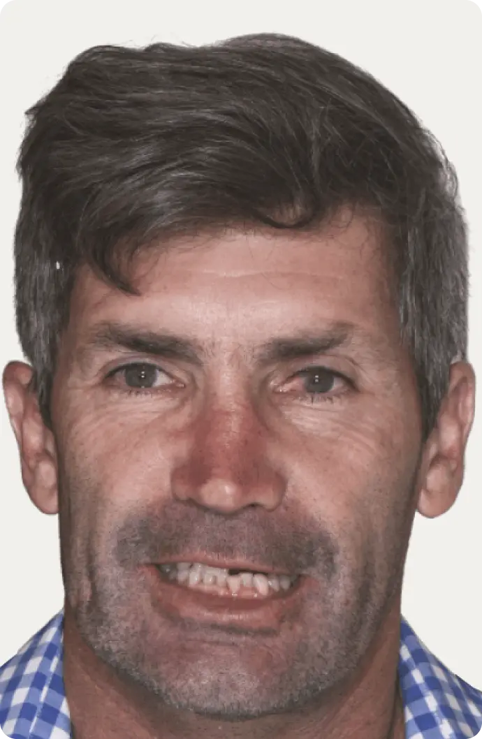 Image of a patient before All-on-4 treatment at Macquarie Street Dental.