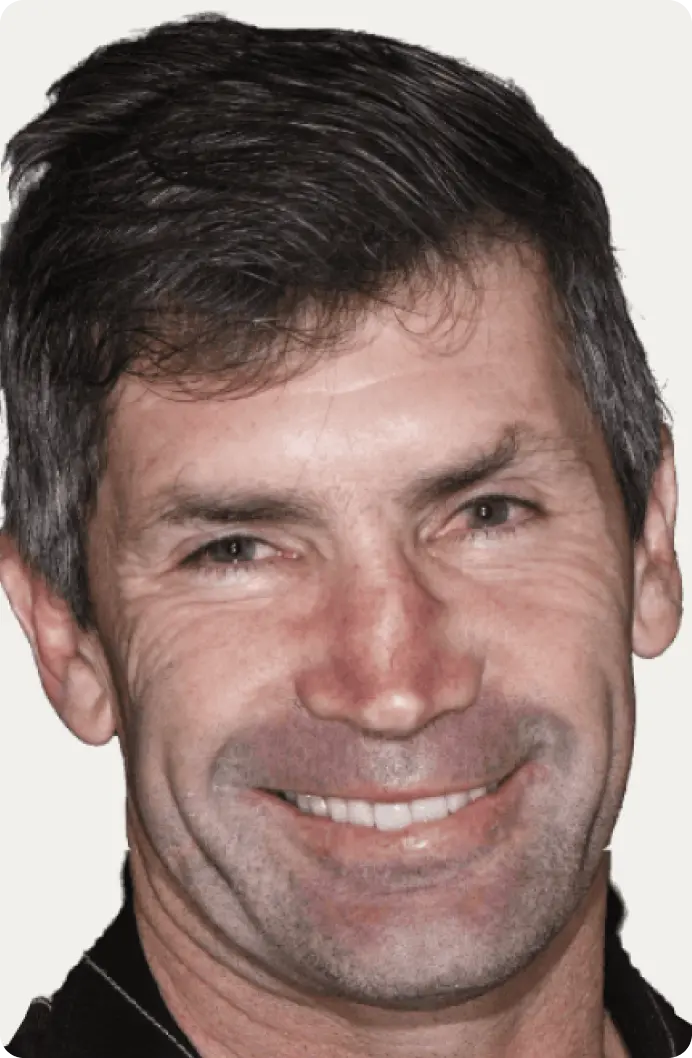 Image of a patient after All-on-4 treatment at Macquarie Street Dental.