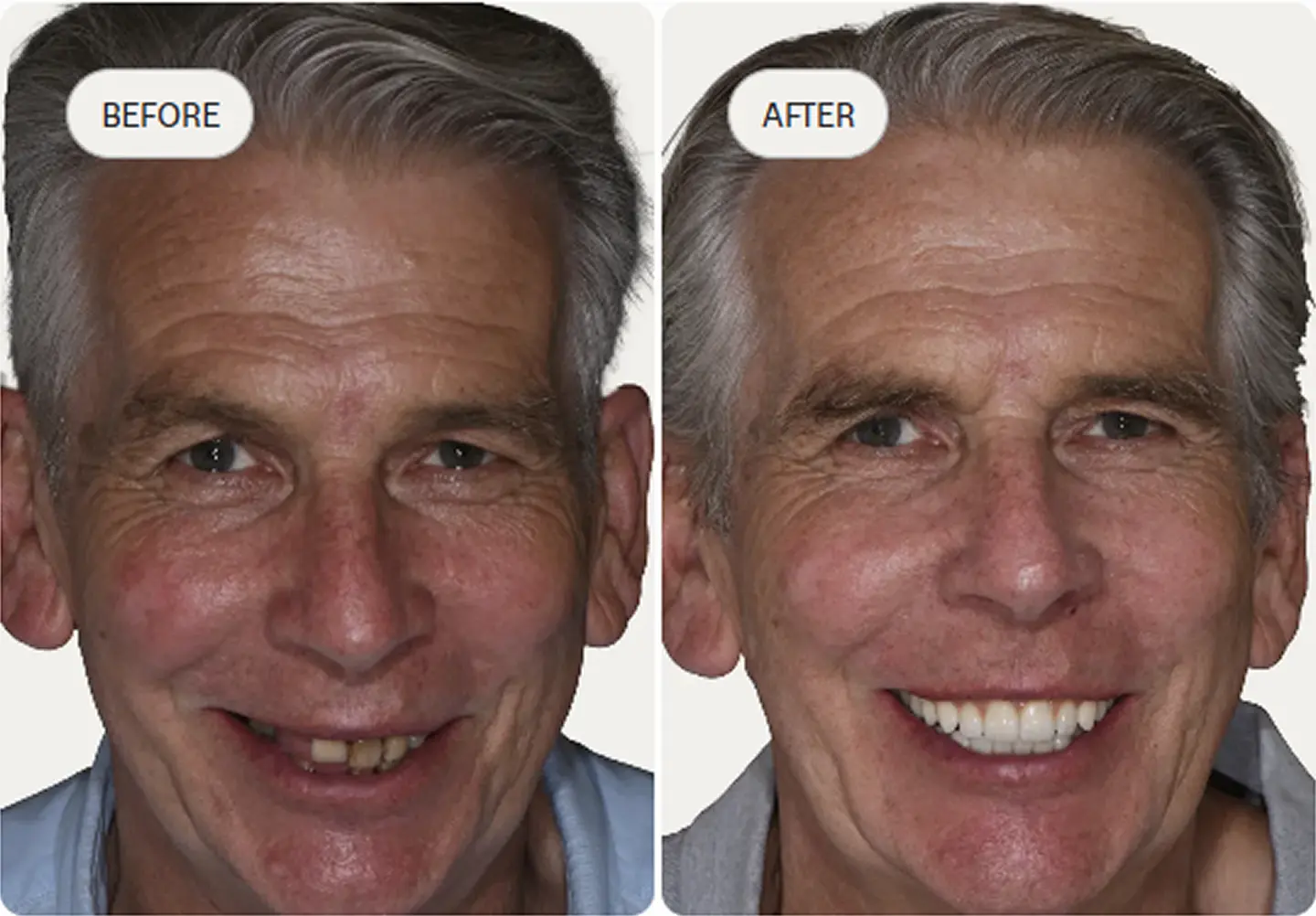 Before and after pictures of a real patient who went through with the all on 4 dental implants procedure.