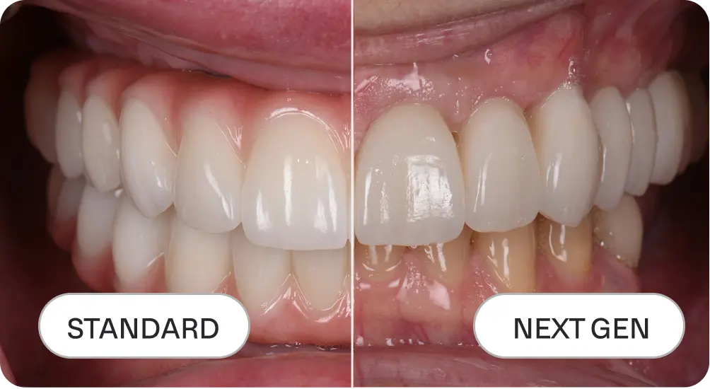 Real patients' photos of standard all-on-4 and next gen