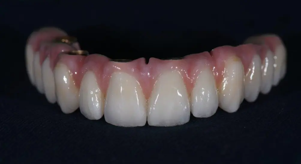 A photo of a real patient's zirconia bridge 