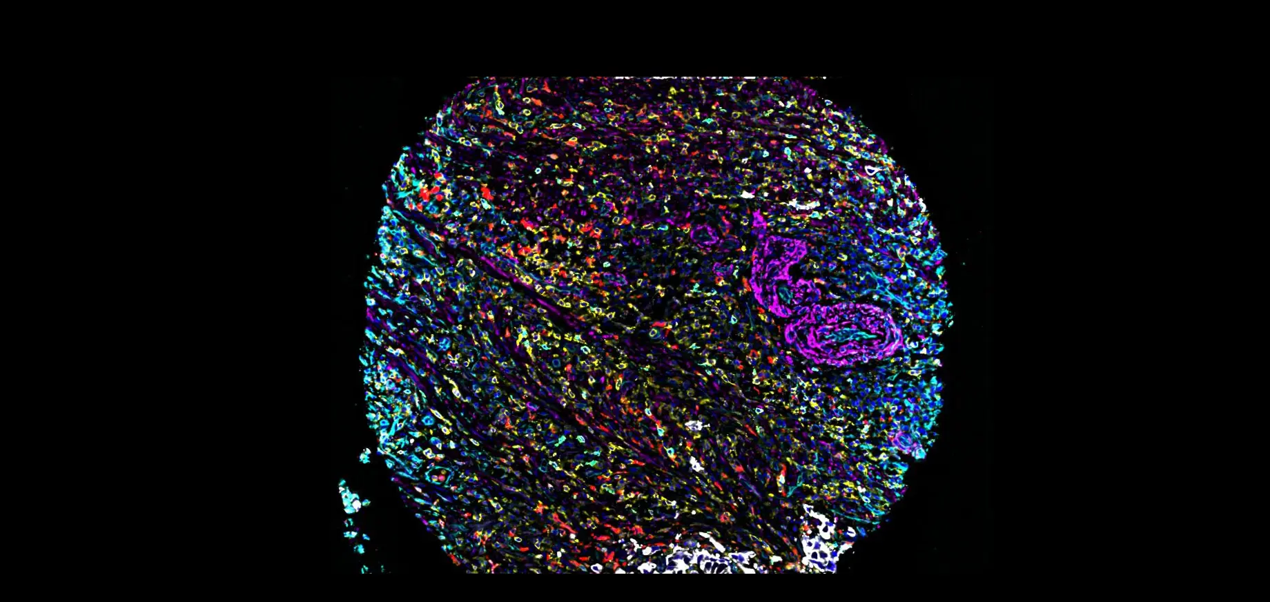 Deep learning model for predicting cancer outcomes