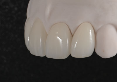 Aesthetic Restorations Essential Smiles Dental Laboratories offers various options for cosmetic restorations. With the combination of high strength, high esthetics, and ease of use, we can whole-heartedly recommend any of these options.