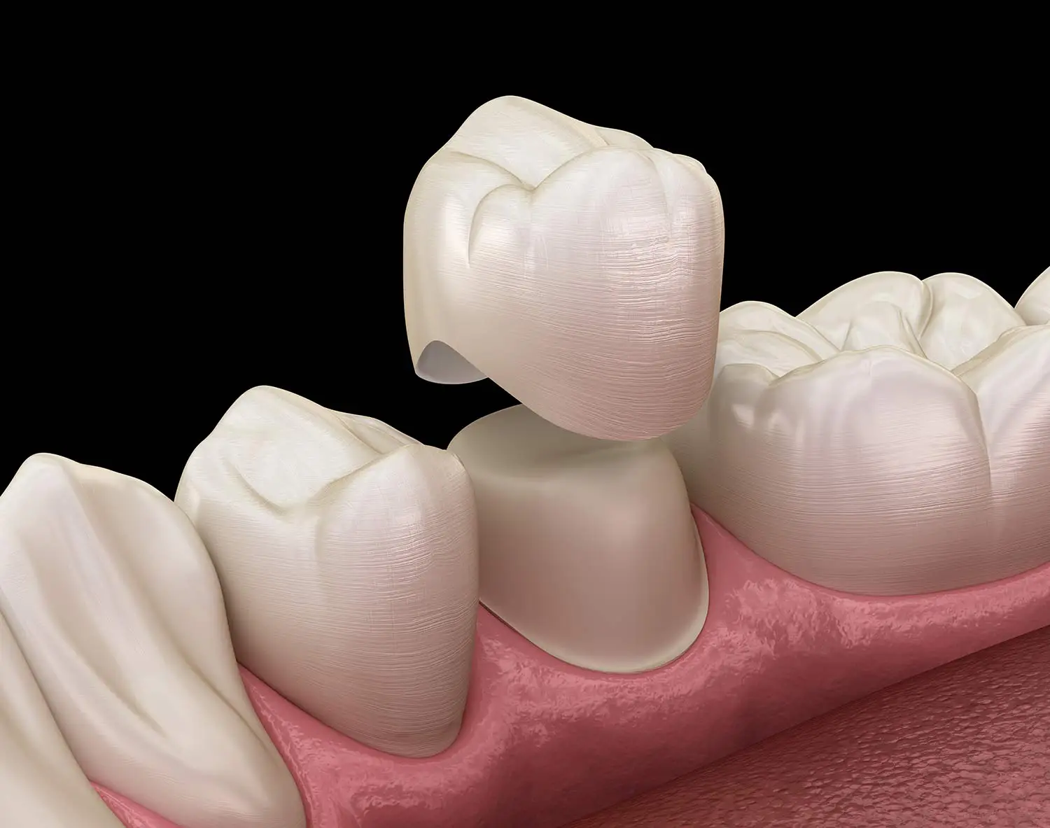 Dental Crowns in Celebration, FL – Lumos Dental Studio