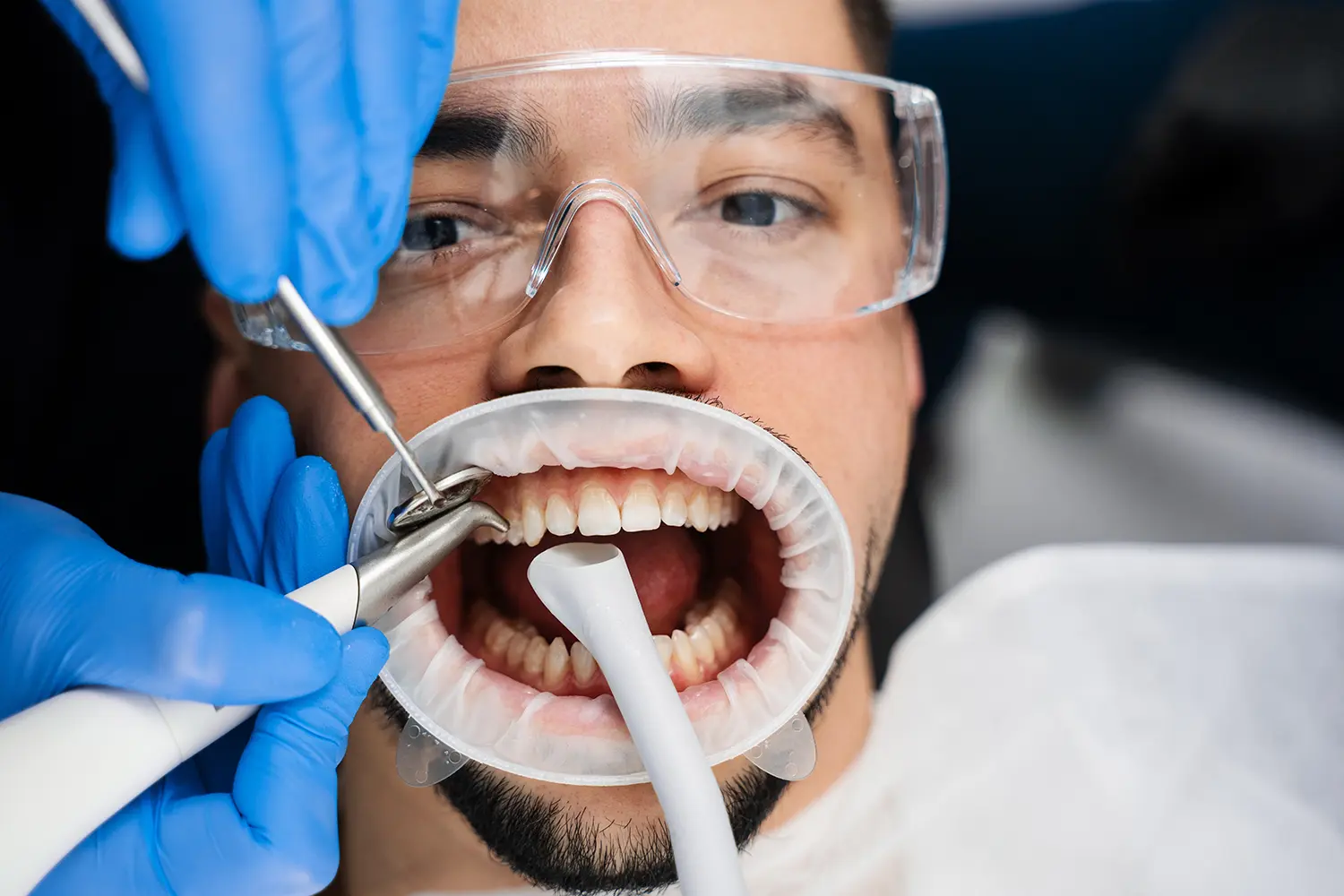 AirFlow Teeth Cleaning in Celebration, FL – Lumos Dental Studio