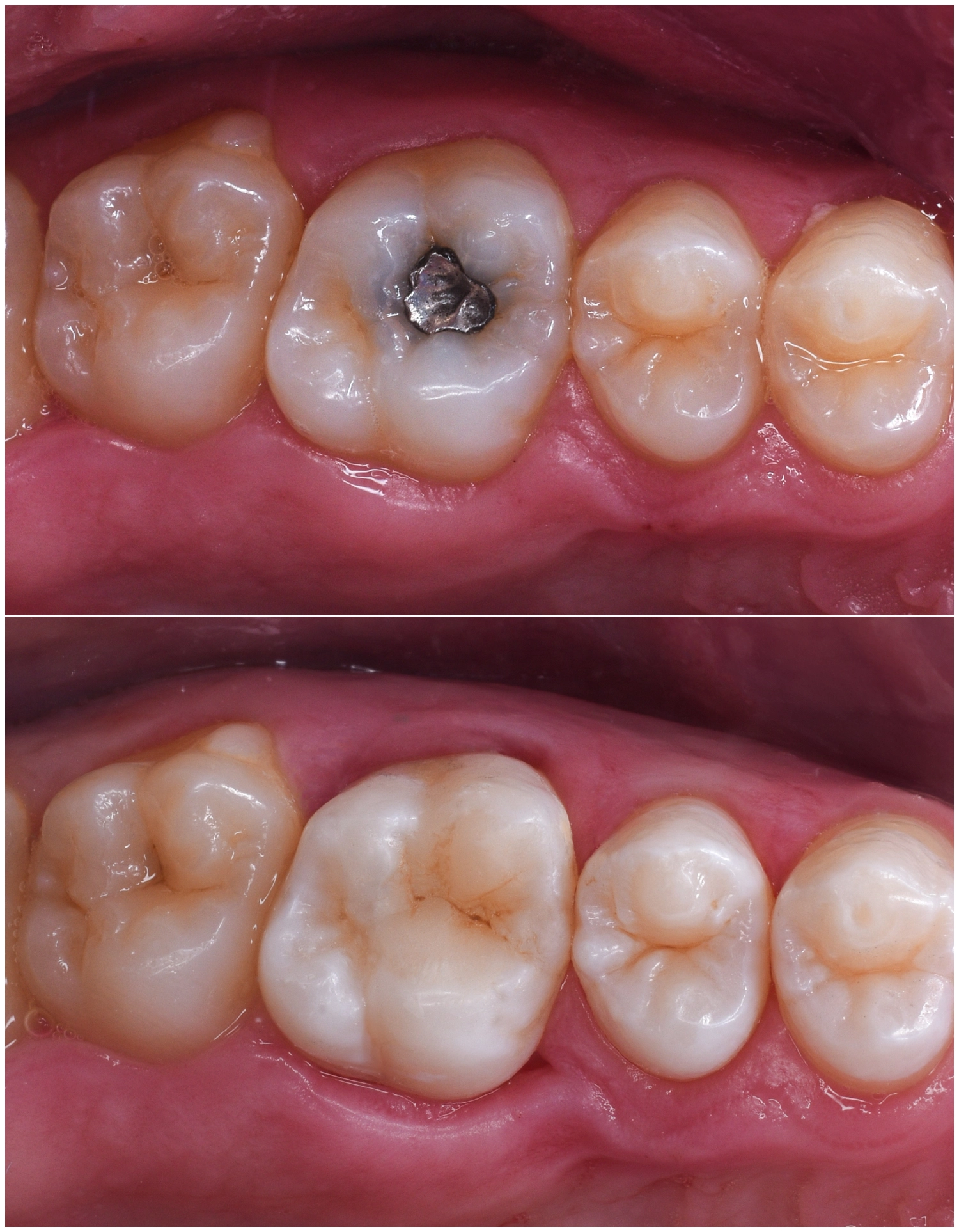 Tooth-Colored Fillings in Celebration, FL – Lumos Dental Studio