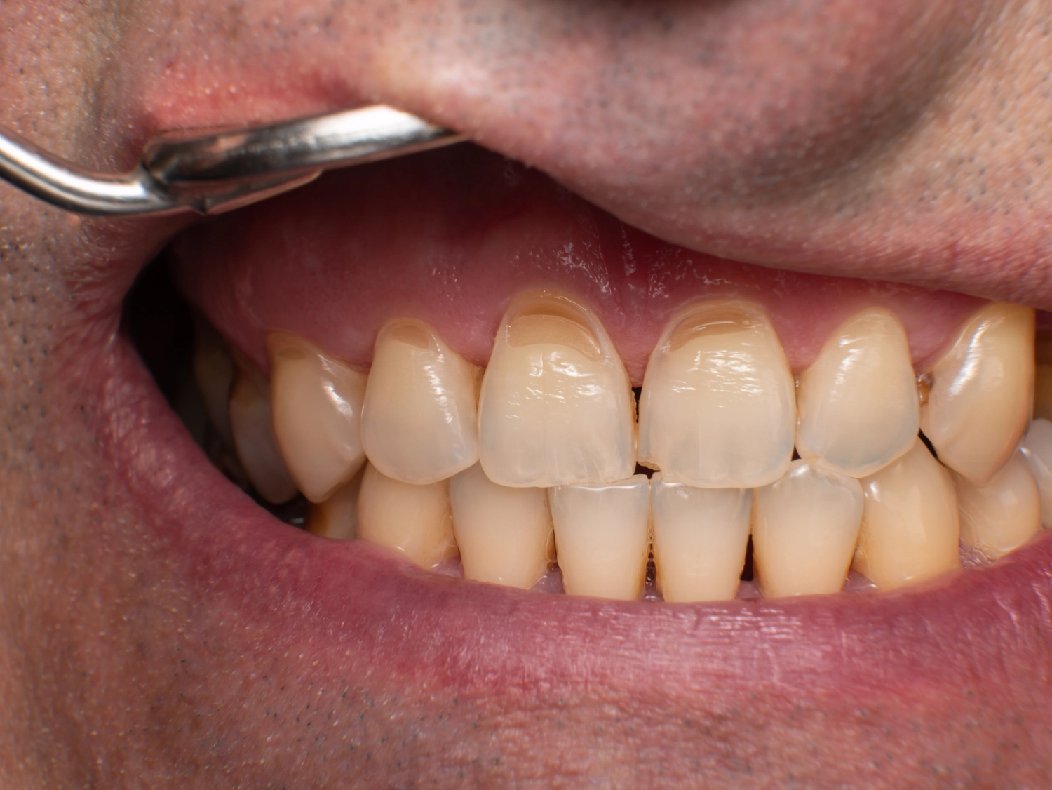 Custom Night Guards in Celebration, FL – Lumos Dental Studio