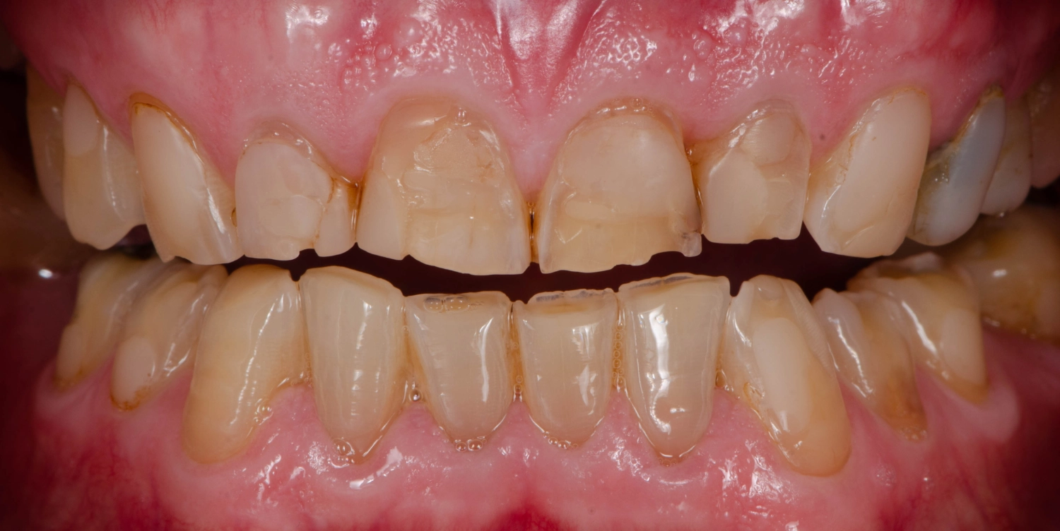 Custom Night Guards in Celebration, FL – Lumos Dental Studio