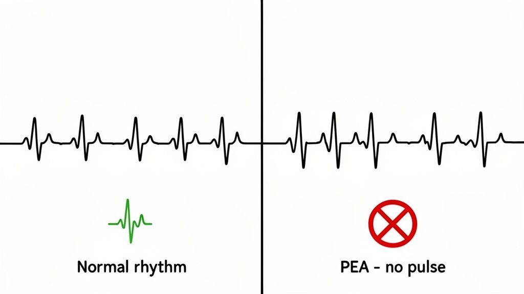 A medical illustration comparing a normal ECG rhythm to pulseless electrical activity (PEA) with no pulse.