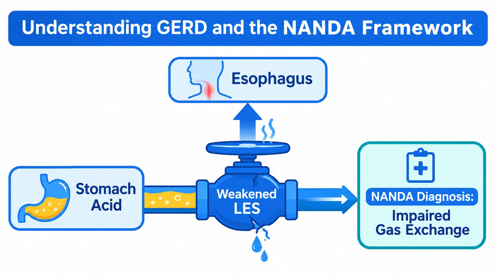 An infographic illustrating GERD and the NANDA framework, depicting a weakened LES valve causing stomach acid reflux.