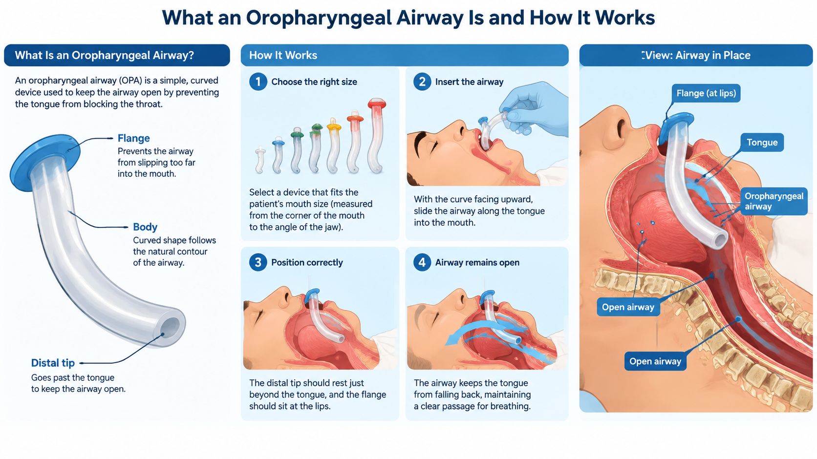 An infographic illustrating how an oropharyngeal airway device is selected and inserted to keep the airway open.