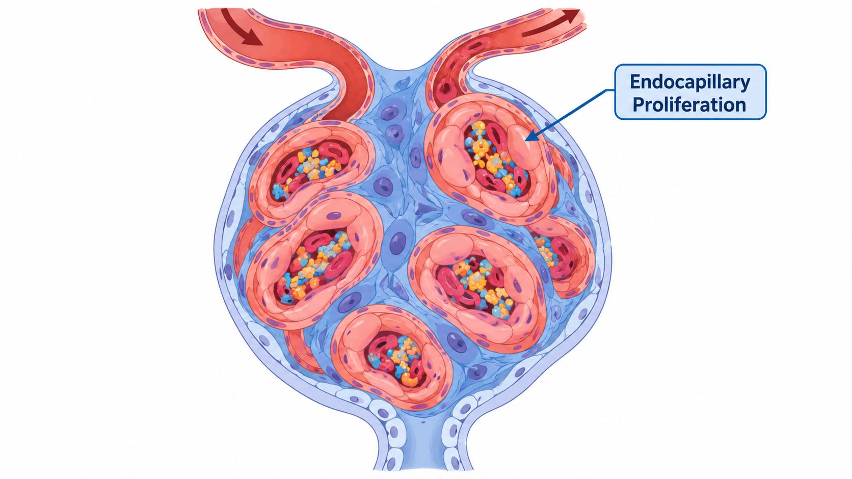 A detailed medical illustration of a kidney glomerulus exhibiting signs of endocapillary proliferation and cellular congestion.