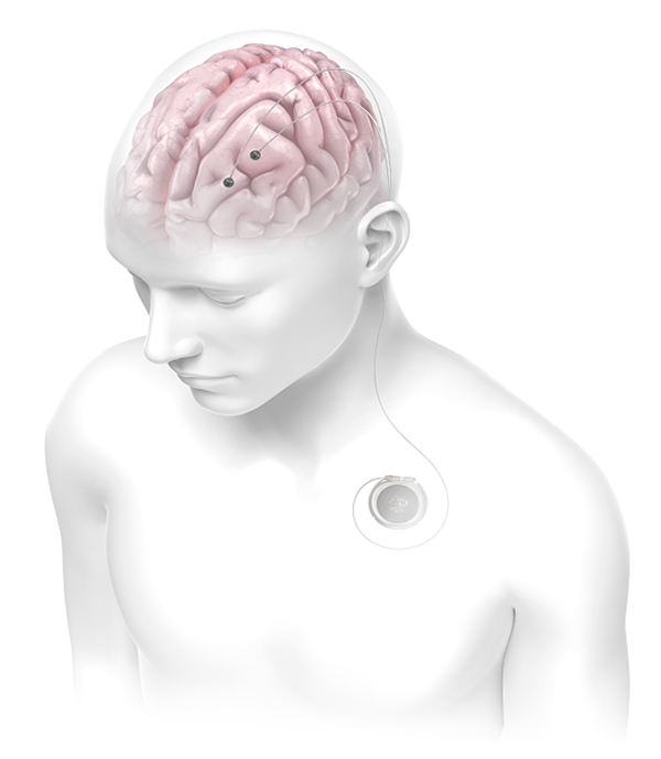 Detailed render of a person using the Connexus Brain-Computer Interface system implanted under the skin