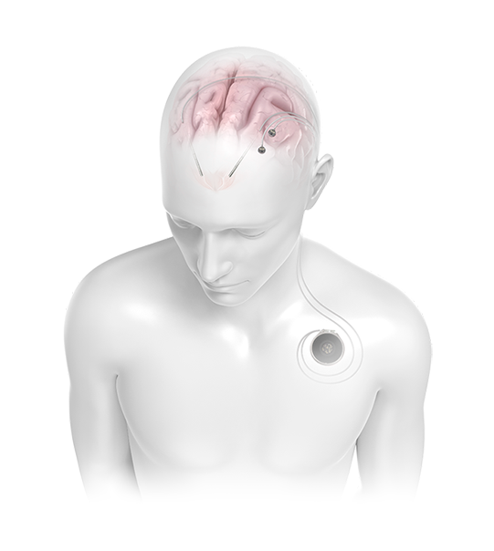 Detailed render of a person using the Connexus Brain-Computer Interface system implanted under the skin