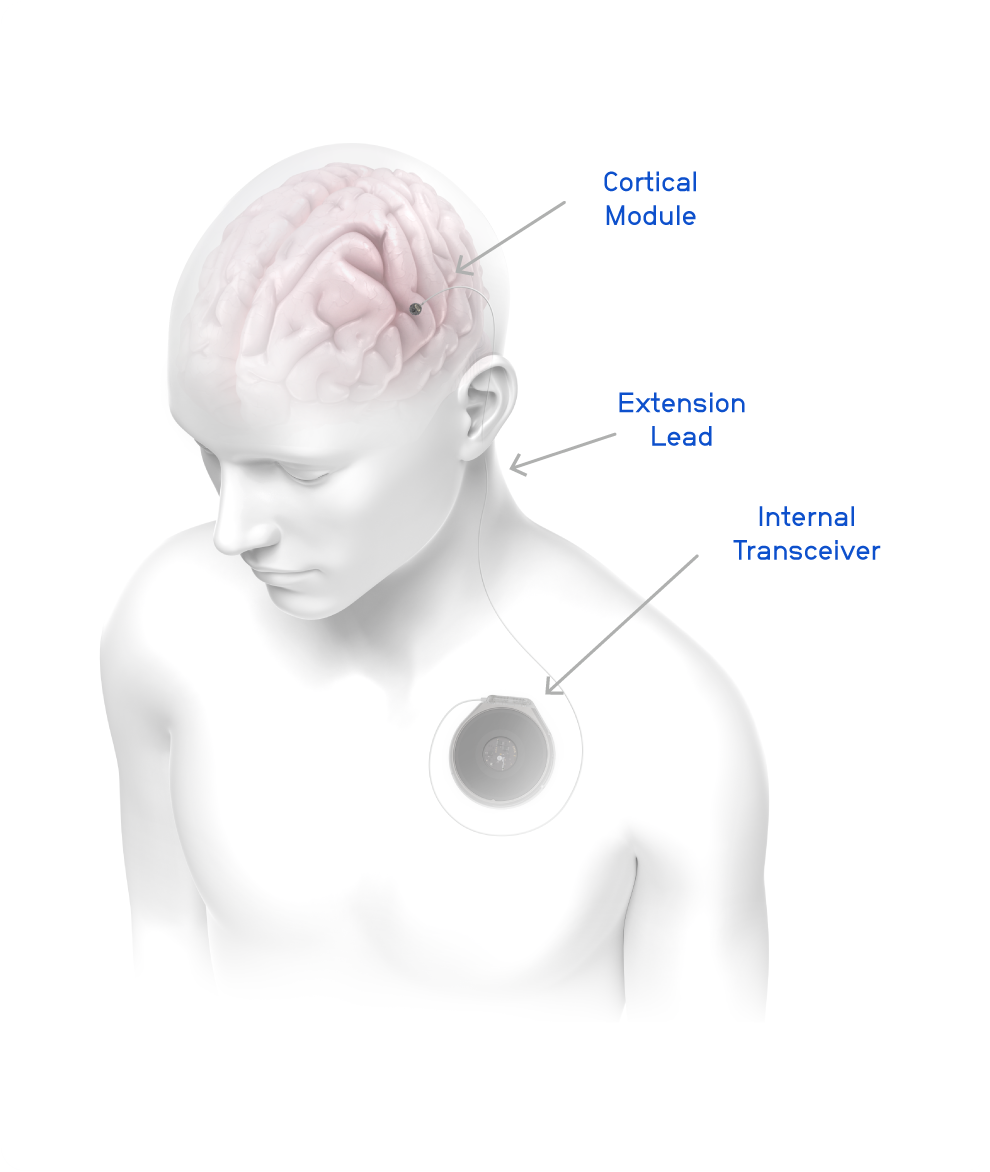 Detailed render of a person using the Connexus Brain-Computer Interface system implanted under the skin