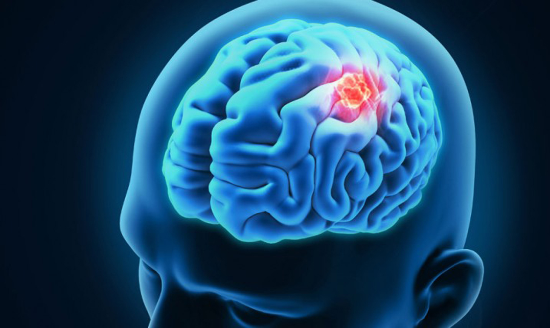 ImmunoCellular Therapeutics Ltd (NYSEMKT:IMUC): What's Behind The Run?