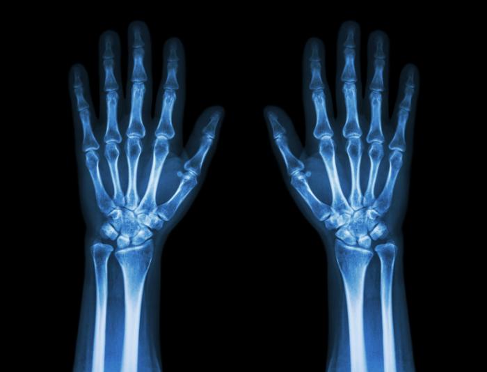 Is Q BioMed Inc (OTCMKTS:QBIO) About To Turnaround?