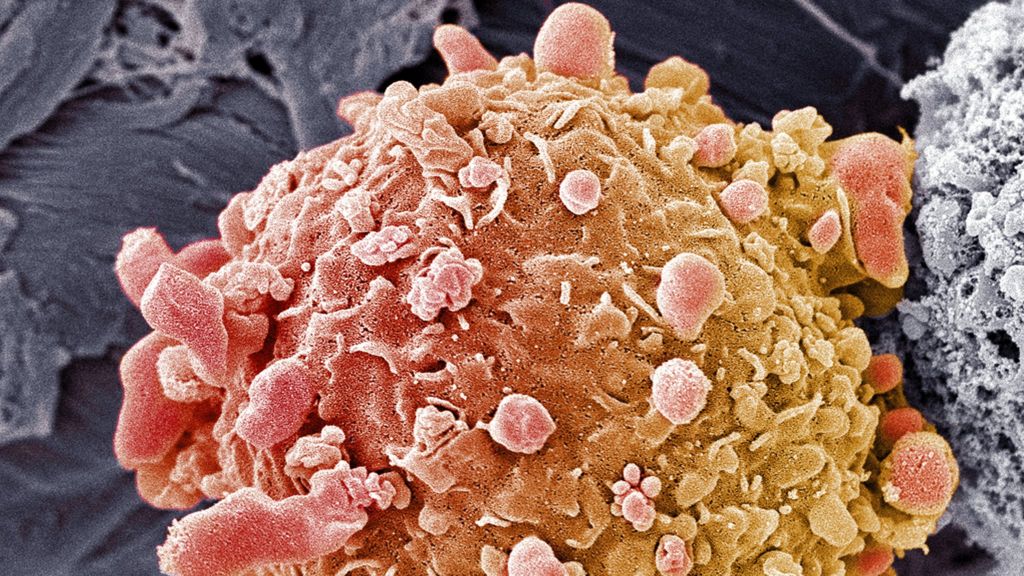 XBiotech Inc (NASDAQ:XBIT) Is Down But Not Out