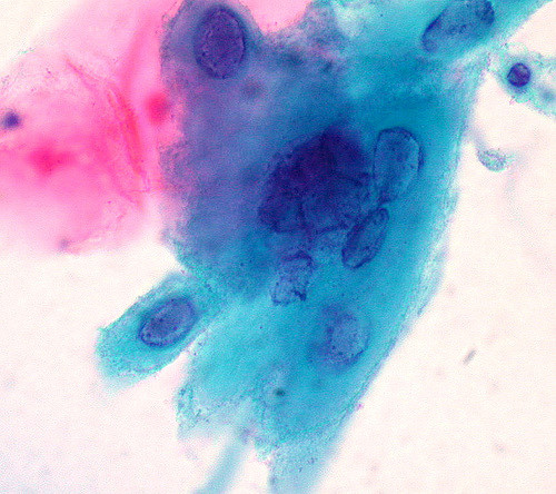 Here's Why We Are Strongly Bullish On Genocea Biosciences Inc (NASDAQ:GNCA)