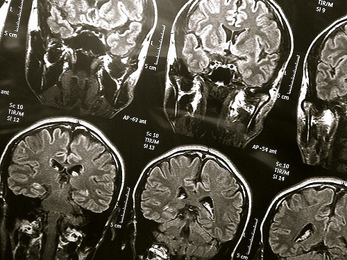 Here's Where The Latest Northwest Biotherapeutics, Inc (OTCMKTS:NWBO) News Fits Into The Picture