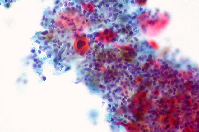 Here's What Just Happened With Kura Oncology Inc (NASDAQ:KURA)