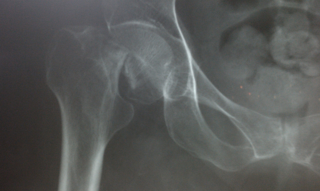 Viking Therapeutics Inc (NASDAQ:VKTX) Is Running: Here's Why