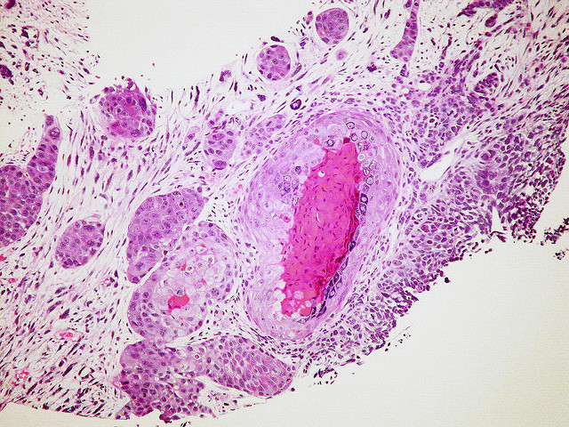 Propanc Biopharma Inc (OTCMKTS:PPCB) Is A Rewarding Cancer Play