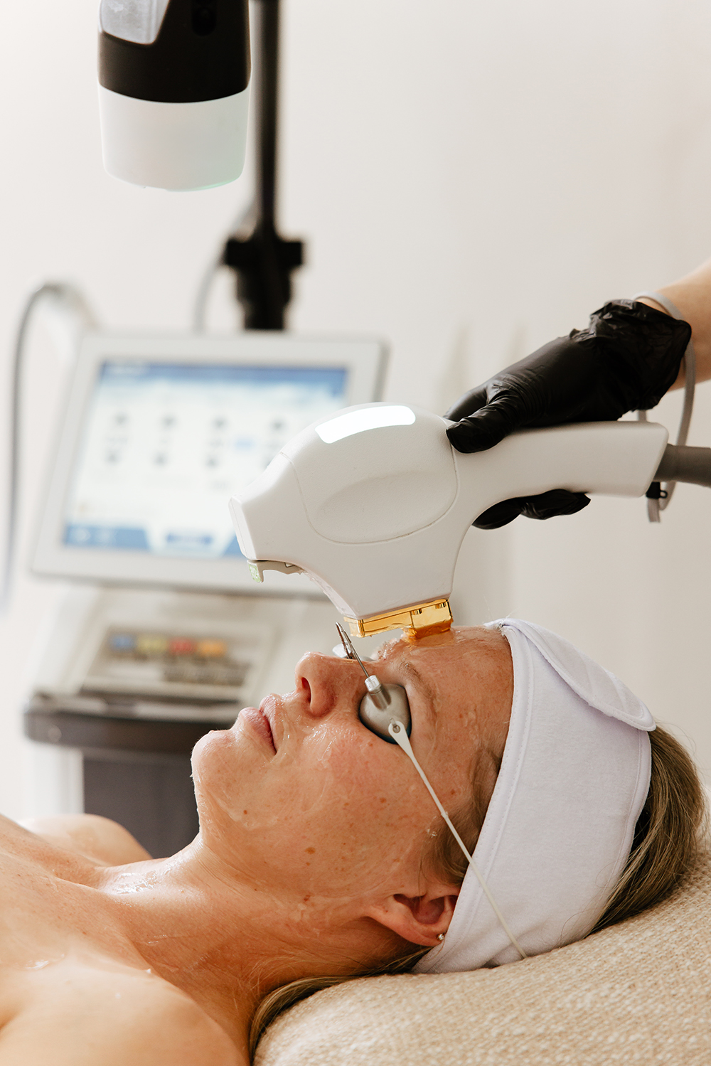 Zabieg fototerapii fotoodmłodzenia BBL w Aestheco Warsaw – wyraźny efekt odmłodzenia