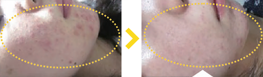 Efekty peelingu BHA – redukcja niedoskonałości skóry, Aestheco Warsaw