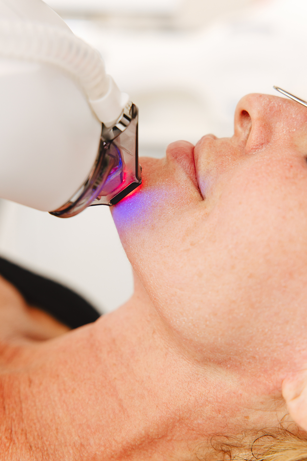 HALO TRIBRID trzy długości fal – kompleksowe odmłodzenie skóry, Warszawa